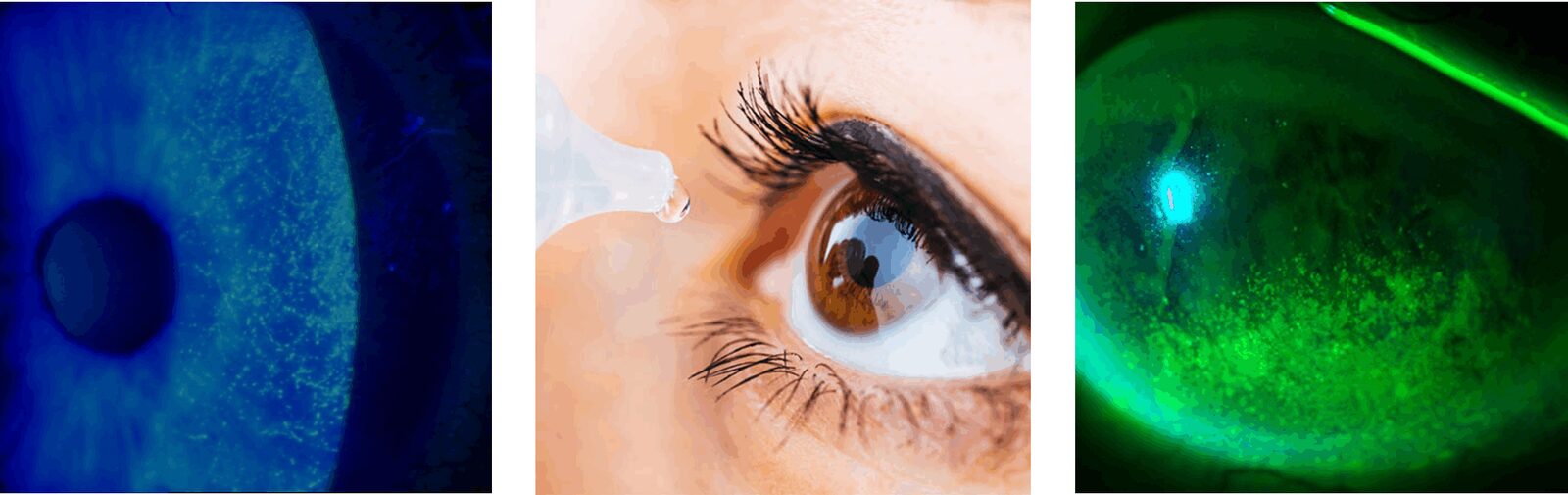 photo - dry eye